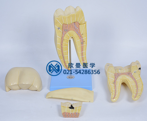 磨牙蛀牙模型分解為2部件結(jié)構(gòu)